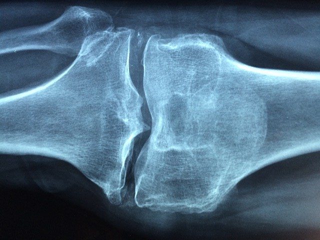 Die Zulassungsstudie für die Arthrosebehandlung mit Befeldungtherapie